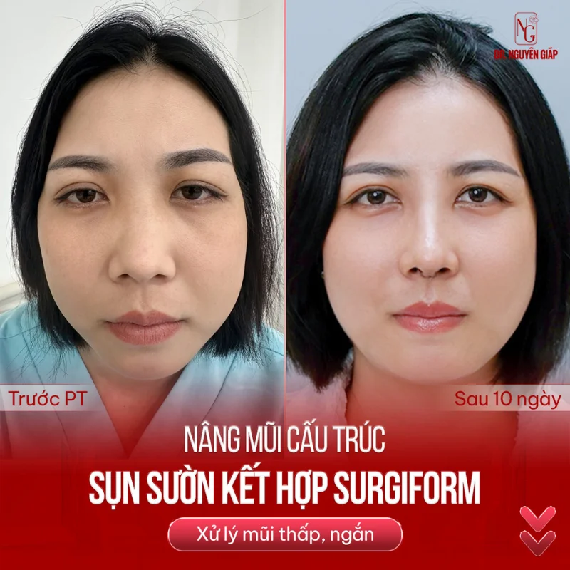 mẹo làm mũi cao nhờ phẫu thuật