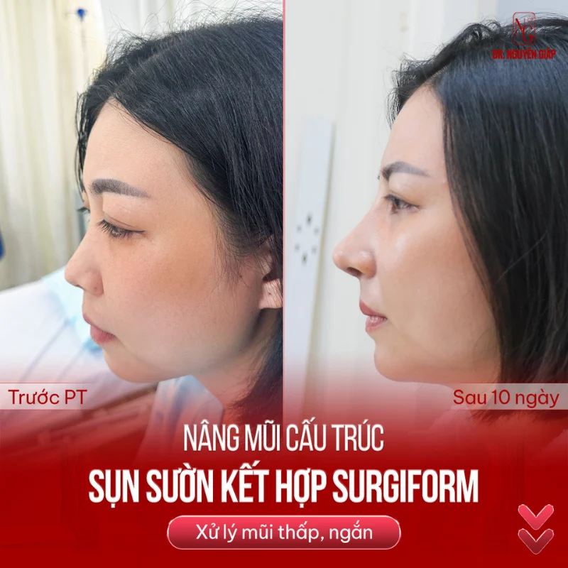 sau 18 tuổi vẫn muốn nâng mũi