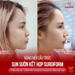 So sánh sụn Surgiform và sụn Softxil