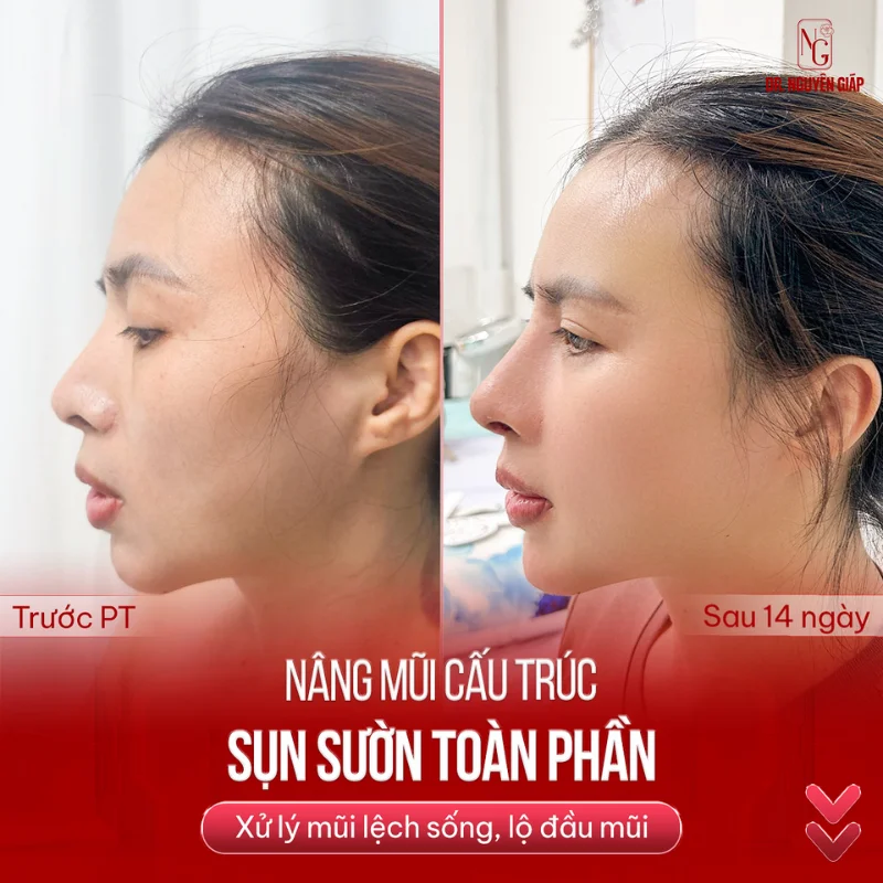 thay đổi kiểu mũi đẹp nhờ phẫu thuật thẩm mỹ