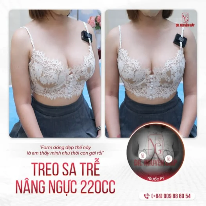 treo sa trễ nâng ngực 220cc