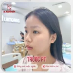 Tuổi Dậy Thì Có Làm Mũi Cao Lên Không?