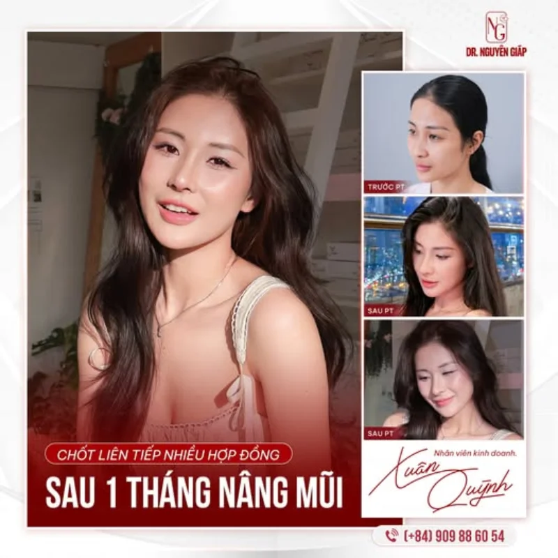 Tuổi dậy thì có nâng mũi thẩm mỹ được không?