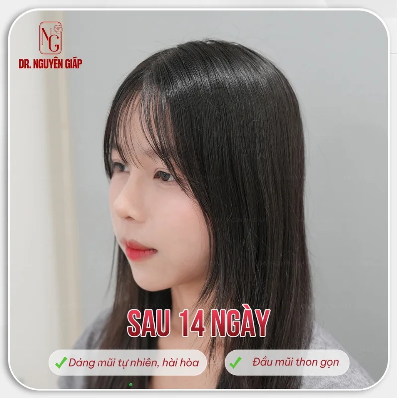 tuổi dậy thì nâng mũi sẽ như thế nào