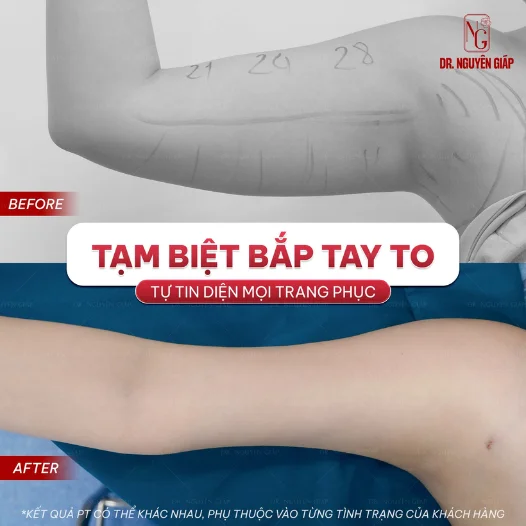 client after using the services liposuction biceps