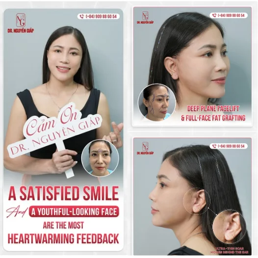 Facelift solution by Doctor Nguyen Giap