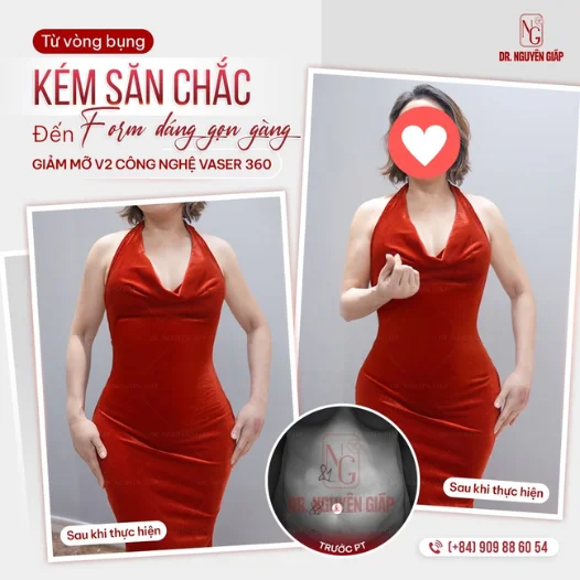 Man lot xac ngoan muc voi dich vu hut mo bung provides bac si Nguyen Giap