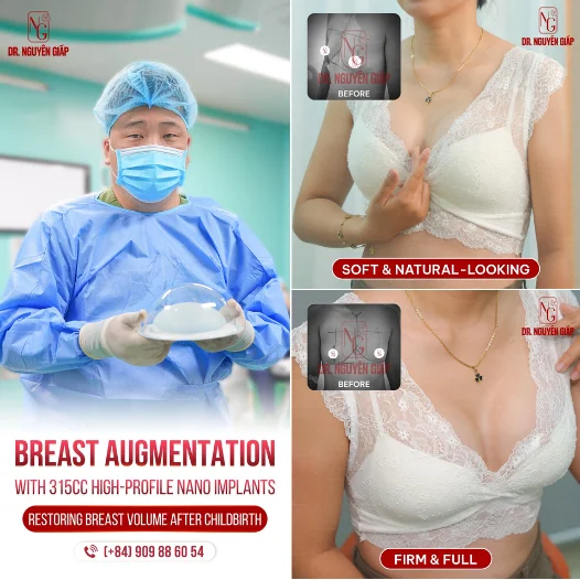 Review of a case using 315cc breast implants