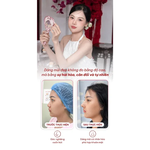 Sau-sinh-bao-lau-co-the-can-nhac-nang-mui Sau sinh bao lâu có thể cân nhắc nâng mũi?