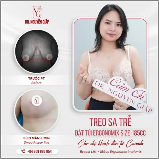 Treo sa trễ v1 là gì