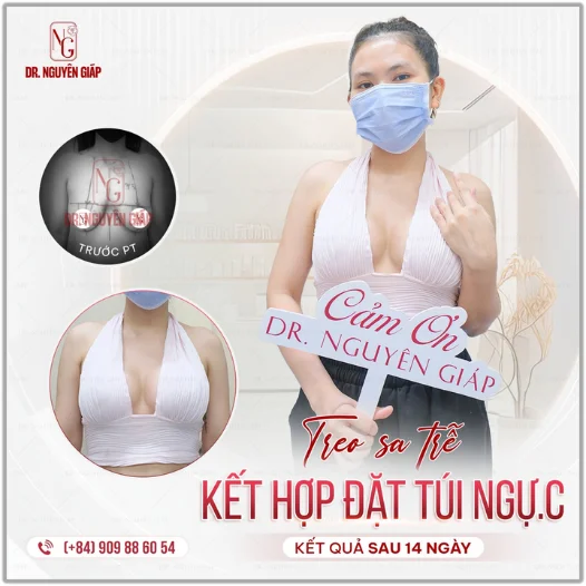 Túi ngực Ergonomix 2 là gì