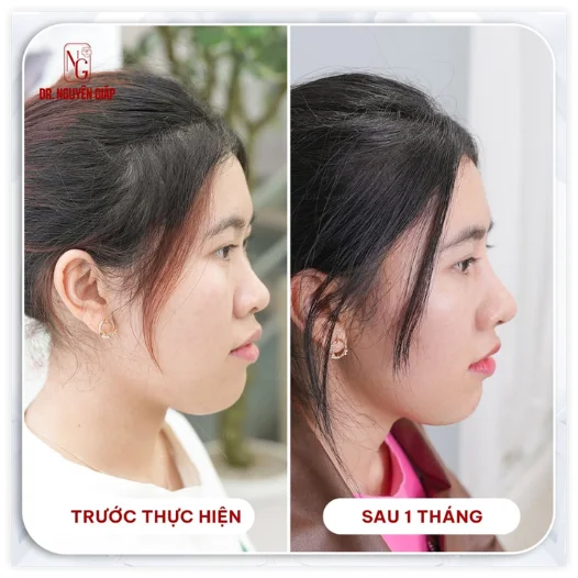 customer gallery malaysia rhinoplasty in VN