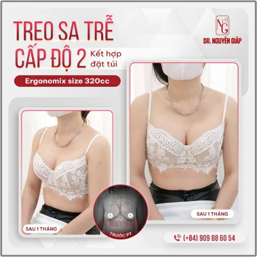 khach-hang-sau-Nang-nguc-Ergonomix-2 khách hàng sau Nâng ngực Ergonomix 2