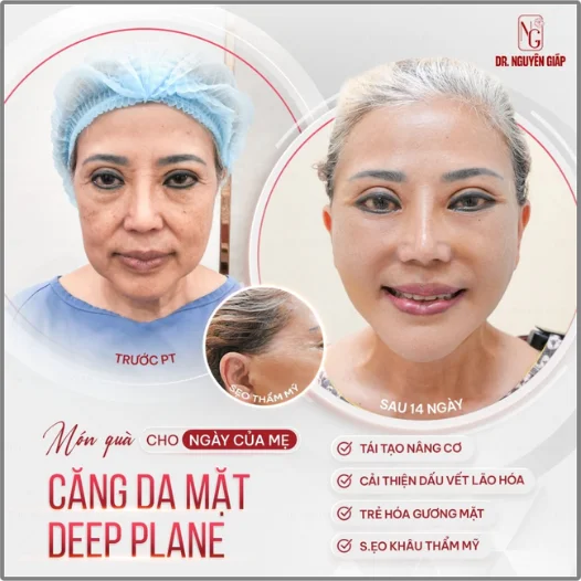 khách hàng trải nghiệm phương pháp deep plane facelift