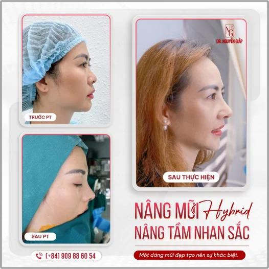Malaysian customer reviews her experience with rhinoplasty in Vietnam.