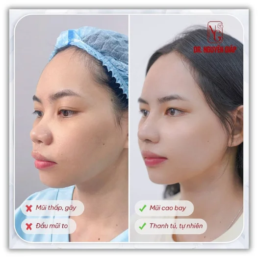 nang-mui-cau-truc-khac-gi-nang-mui-thuong Nâng mũi cấu trúc khác gì nâng mũi thường