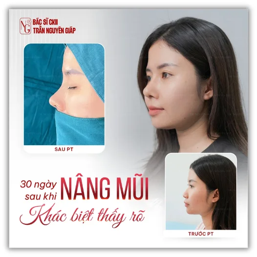 nang-mui-thuong-va-nang-mui-cau-truc nang mui thuong va nang mui cau truc