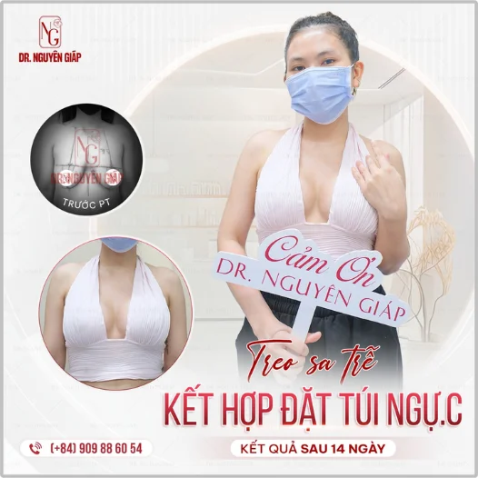 phương pháp phẫu thuật treo sa trễ v1