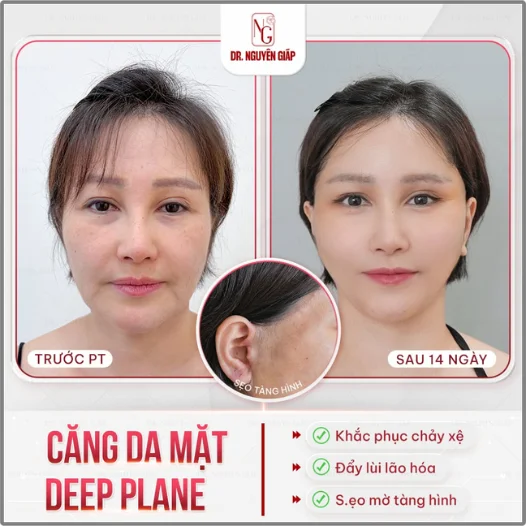 trai nghiem cang da mat deep plane cua kylie marie