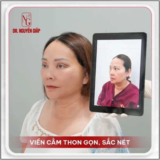 trước và sau khi thực hiện kỹ thuật căng da mặt tại dr nguyên giáp