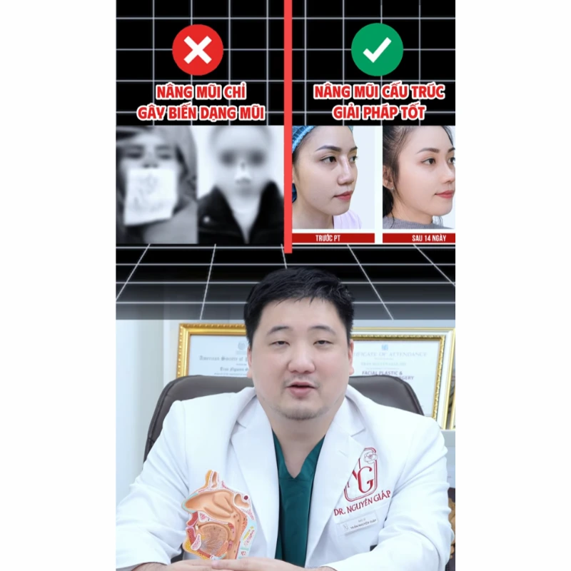 cac-phuong-phap-nang-mui-an-toan-change-the-nang-mui-bang-chi Safe rhinoplasty methods replace rhinoplasty with thread