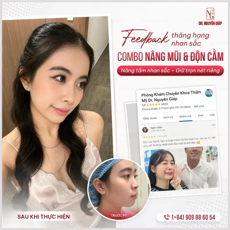 combo-nang-mui-va-don-cam-ear-bac-si-nguyen giap rhinoplasty structure at the doctor Nguyen Giap